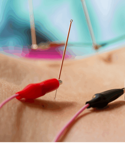 electro acupuncture | Body First Wellness Center electro acupuncture
